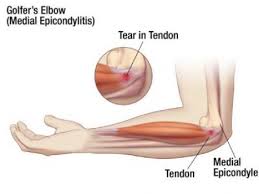 Wrist flexor anatomy of medial epicondylitis/golfer's elbow