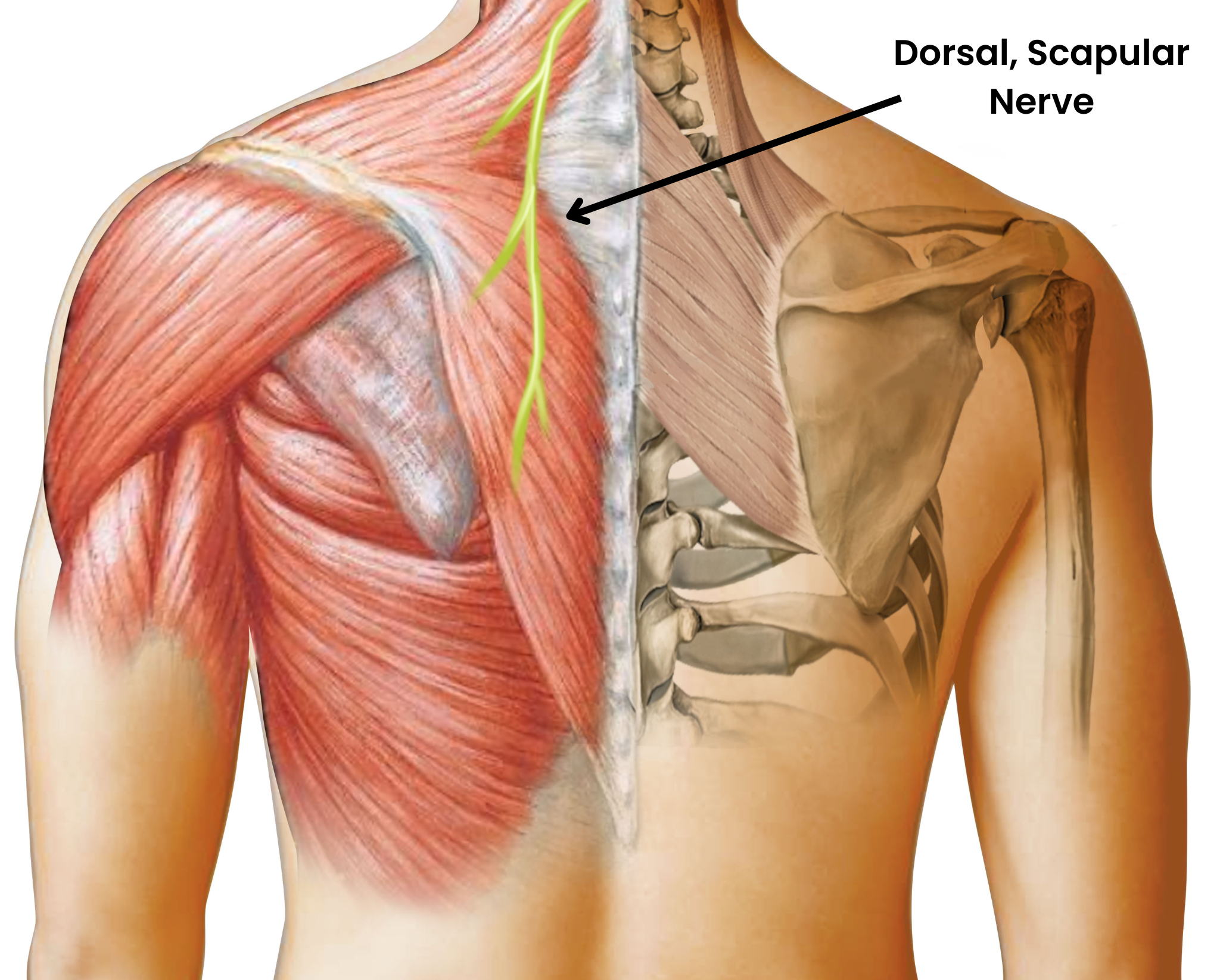 Dorsal Scapular Nerve Entrapment – Shoulder Blade Pain Diagram